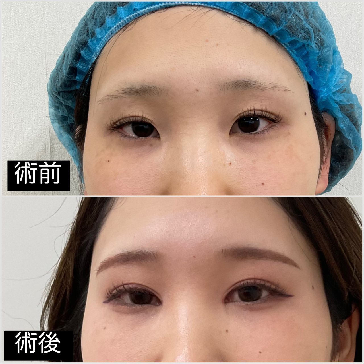 目頭切開