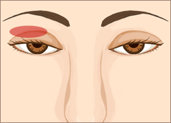 眼瞼下垂（がんけんかすい）の治療方法