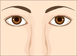 眼瞼下垂（がんけんかすい）の治療方法