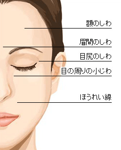 図解 シワのできる場所別と治療法 ユリシスクリニック 浜松市