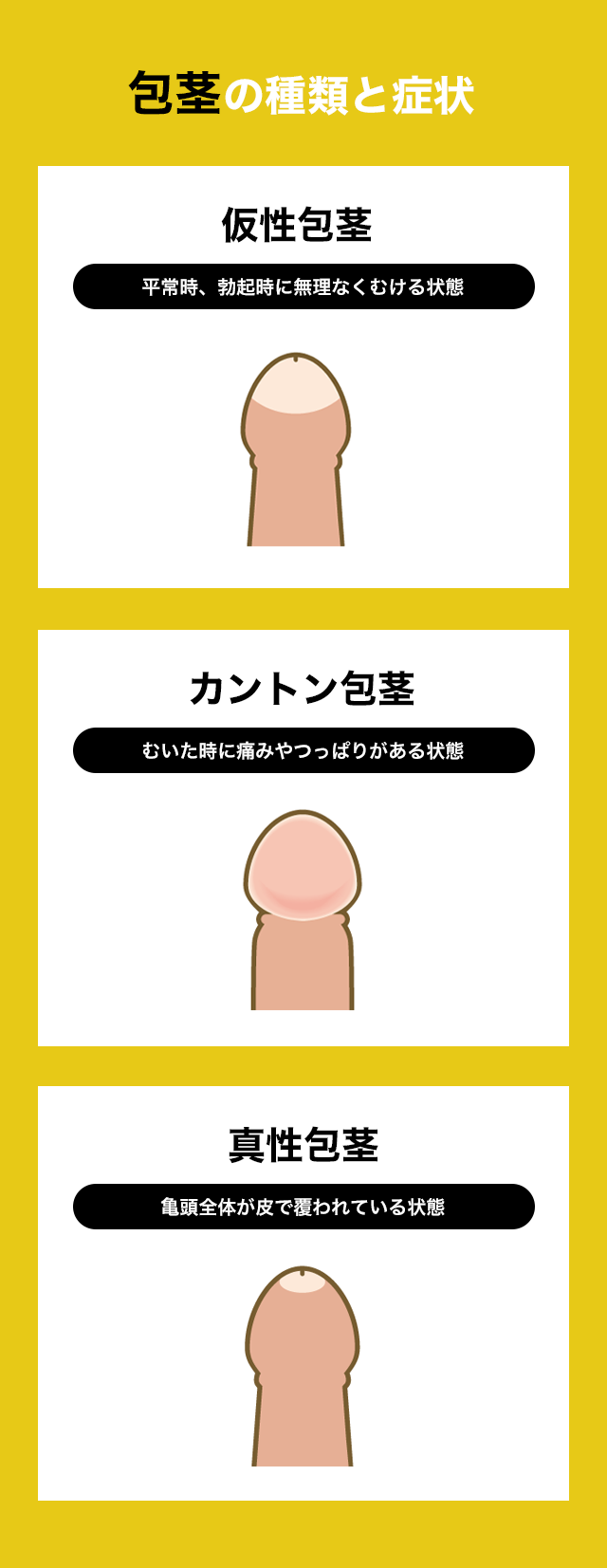 包茎治療の種類